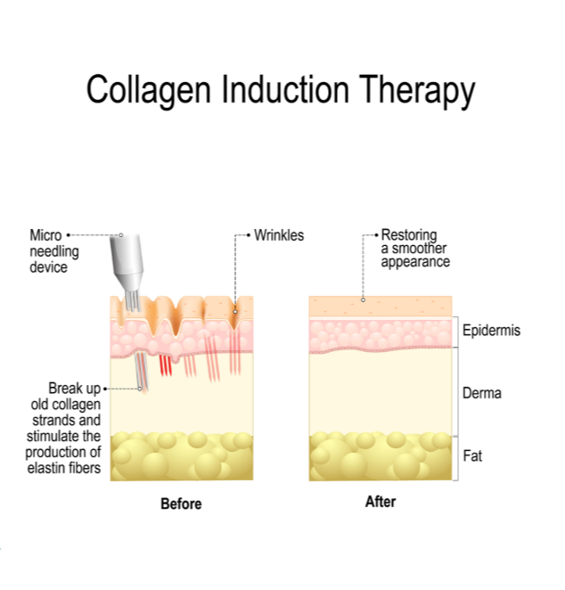Collagen induction therapy (microneedling) is surgical treatment for removing wrinkles.