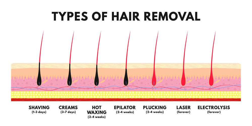 Permanent Hair Removal in Atlanta, GA | Mishael's Electrolysis Center